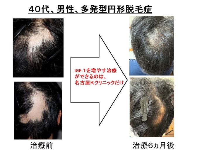 円形脱毛症　病院